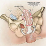 Inflatable Penile Prosthesis