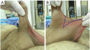 Ventral phalloplasty