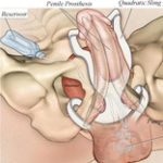 Simultaneous Inflatable Penile Prosthesis