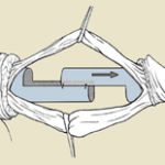 Lengthening Surgical Procedure