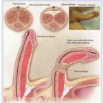 Penile Reconstruction