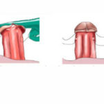 Glans Fixation for Floating Glans 