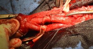 Penile Length Restoration