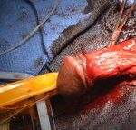 Penile surgery demonstration