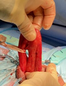penile length restoration surgery