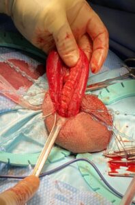 Penile prosthesis surgery 