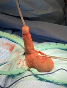 penile length restoration surgery