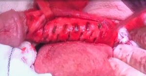 Penile Implant surgical photo