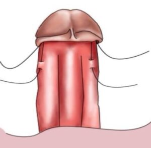 These sutres are then tested for strength 