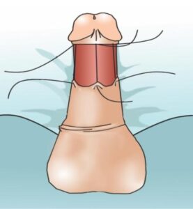 Circumcision is then closed 